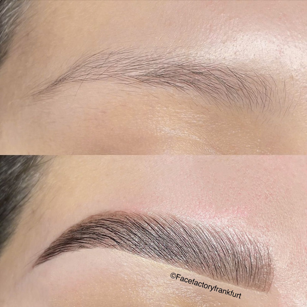 Brow Lifting